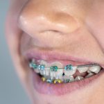 טיפים לשמירה על בריאות השיניים במהלך טיפול יישור שיניים